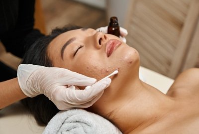 acne-facial